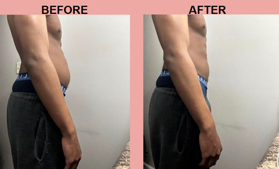 Apple Cider Vinegar Gummies